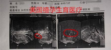 禧孕HRC有卵巢囊肿或水泡能做美国试管婴儿吗？
