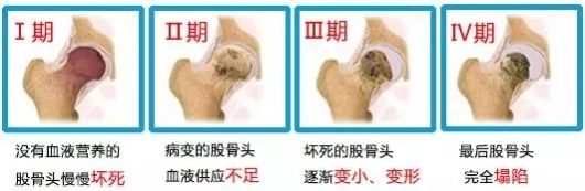对号入座，看看自己的股骨头坏死属于几期
