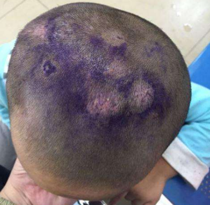 头癣用什么好？老中医是这样说的