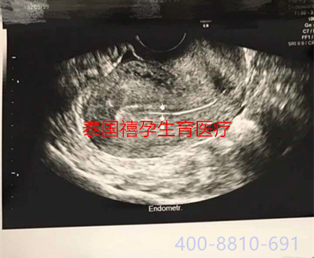 禧孕泰国试管婴儿助不孕不育怀上“好孕气”