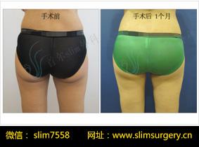 【首尔slim外科】皮肤松弛整形——高满足度的塑臀手术！