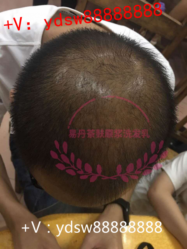 易丹医坊:脱发怎么办？或许就是因为你不懂得怎么洗头导致的！
