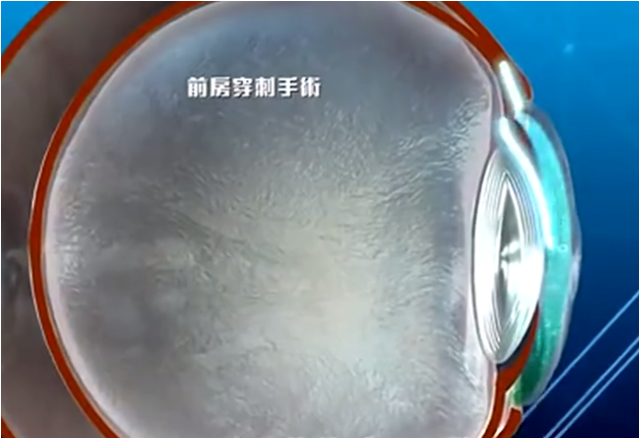 林顺潮首创了领先世界的前房穿刺手术