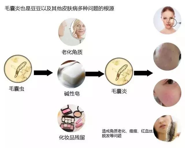 北京美莱医院怎么样--韩国小气泡，给你的小脸“洗”个澡
