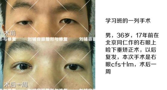 刘辅蓉眼整形修复研究院成立， 是眼整形失败者的福音